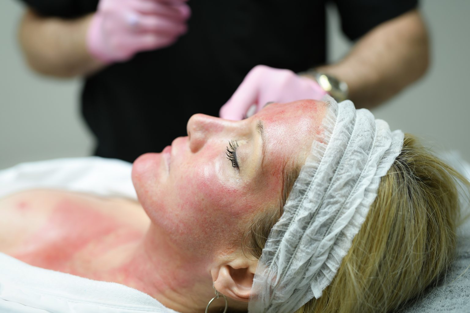 vampire-facial-in-birmingham-al-seiler-skin